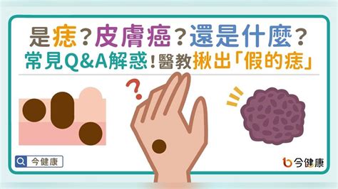 全身痣|是痣？皮膚癌？還是什麼？常見Q&A解惑！醫教揪出「。